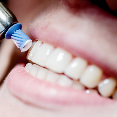 Prophylaxe und professionelle Zahnreinigung